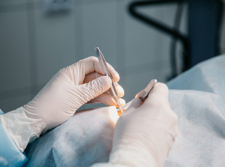 Operacije pterigija nevusa i melanoza spojnice