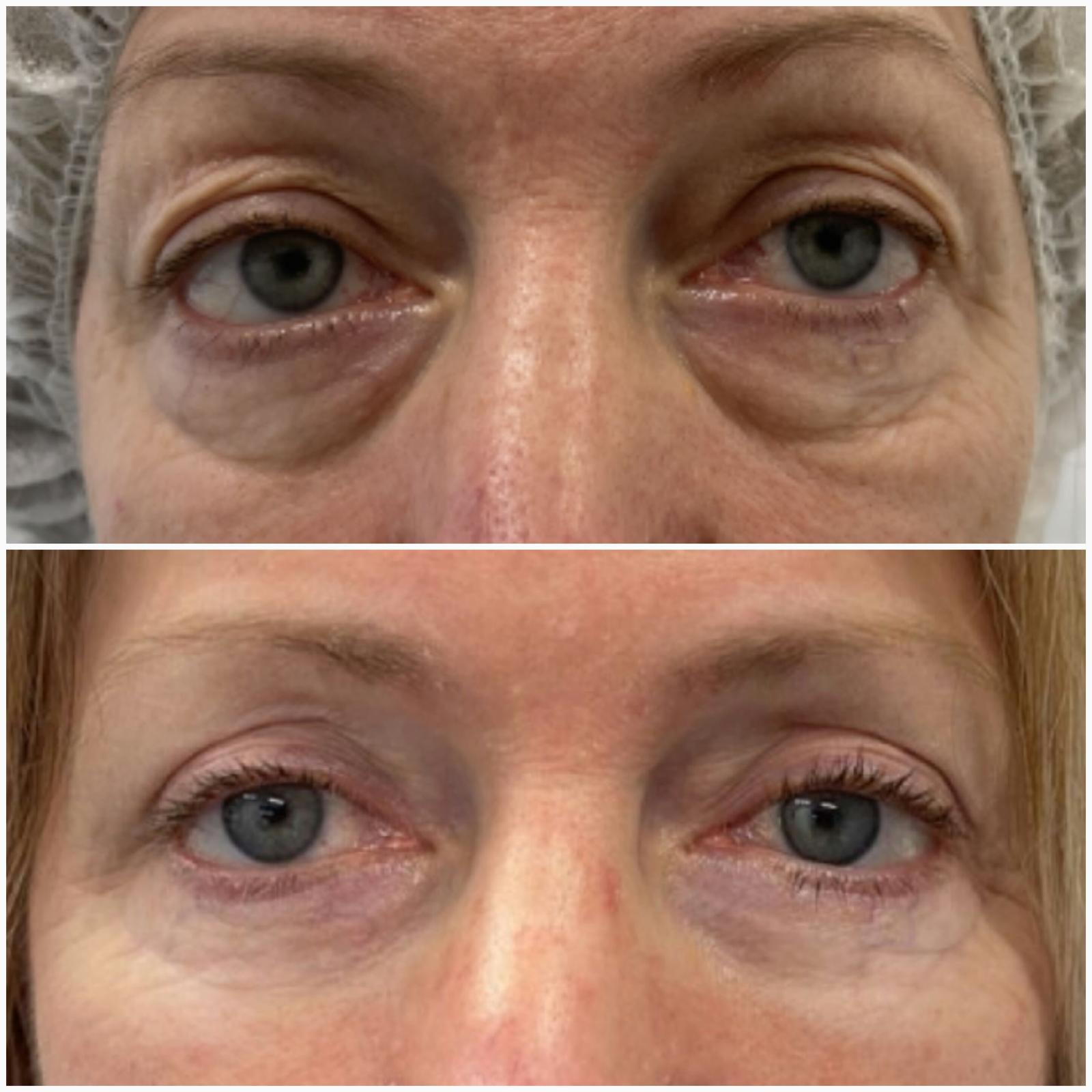 blefaroplastika11