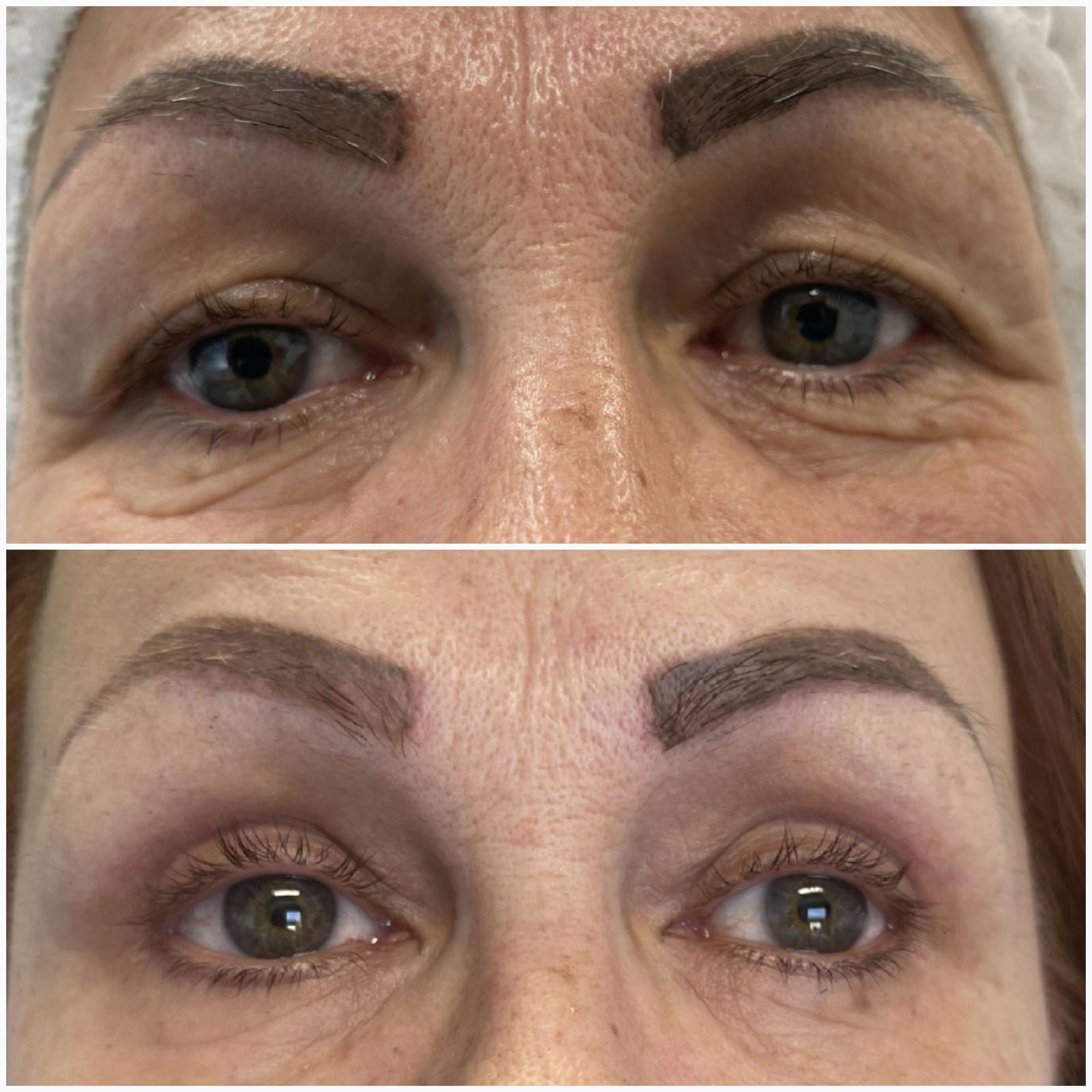 blefaroplastika18