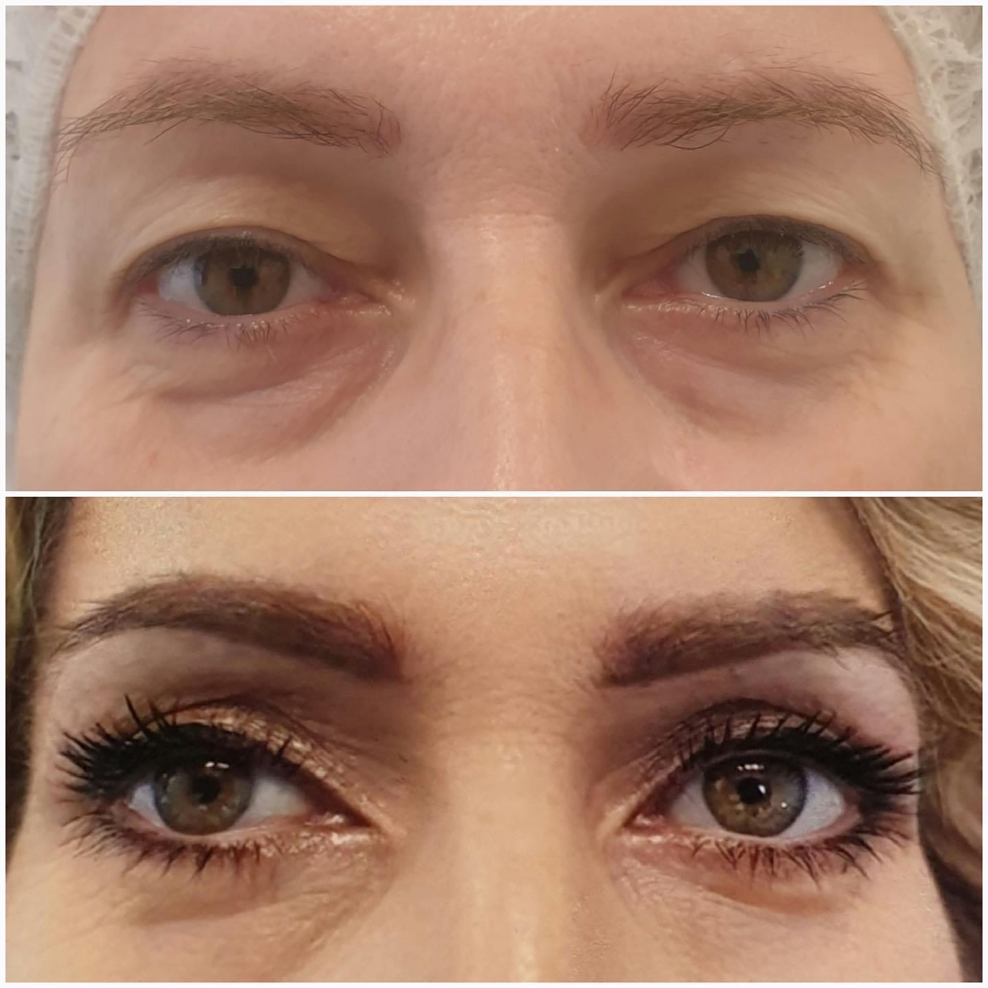 blefaroplastika20