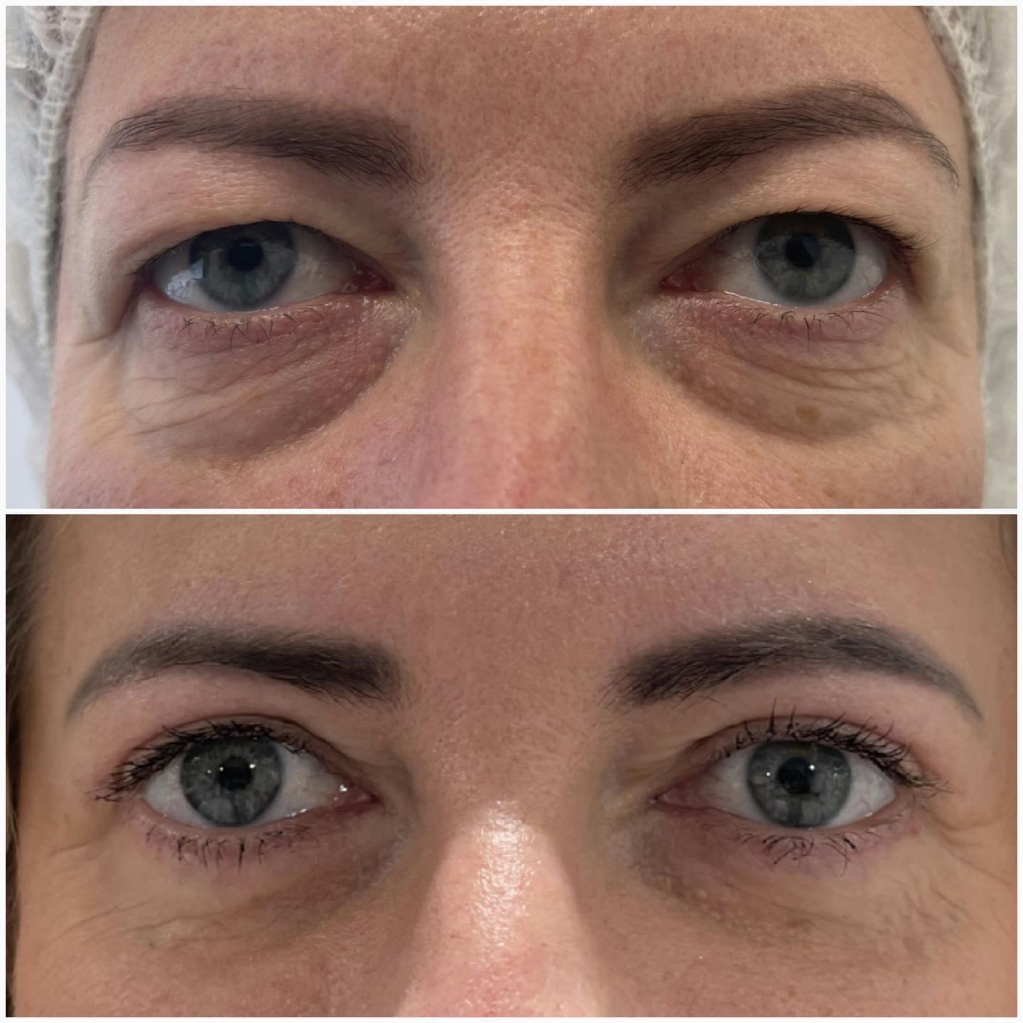 blefaroplastika21