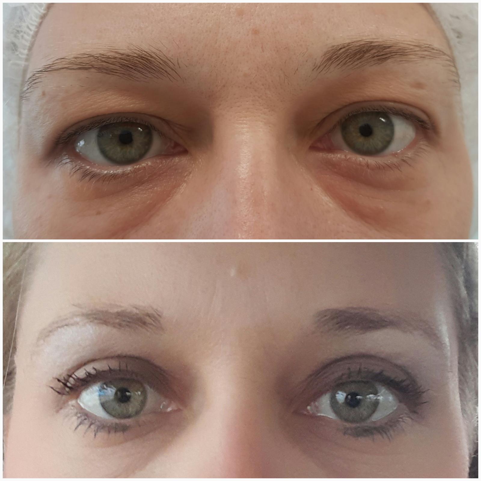 blefaroplastika211