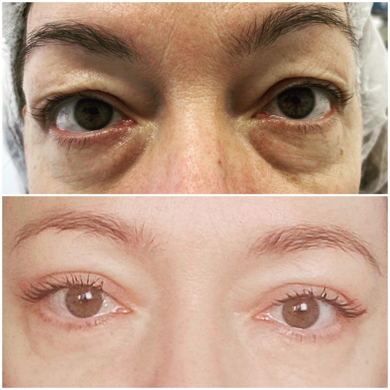 blefaroplastika22