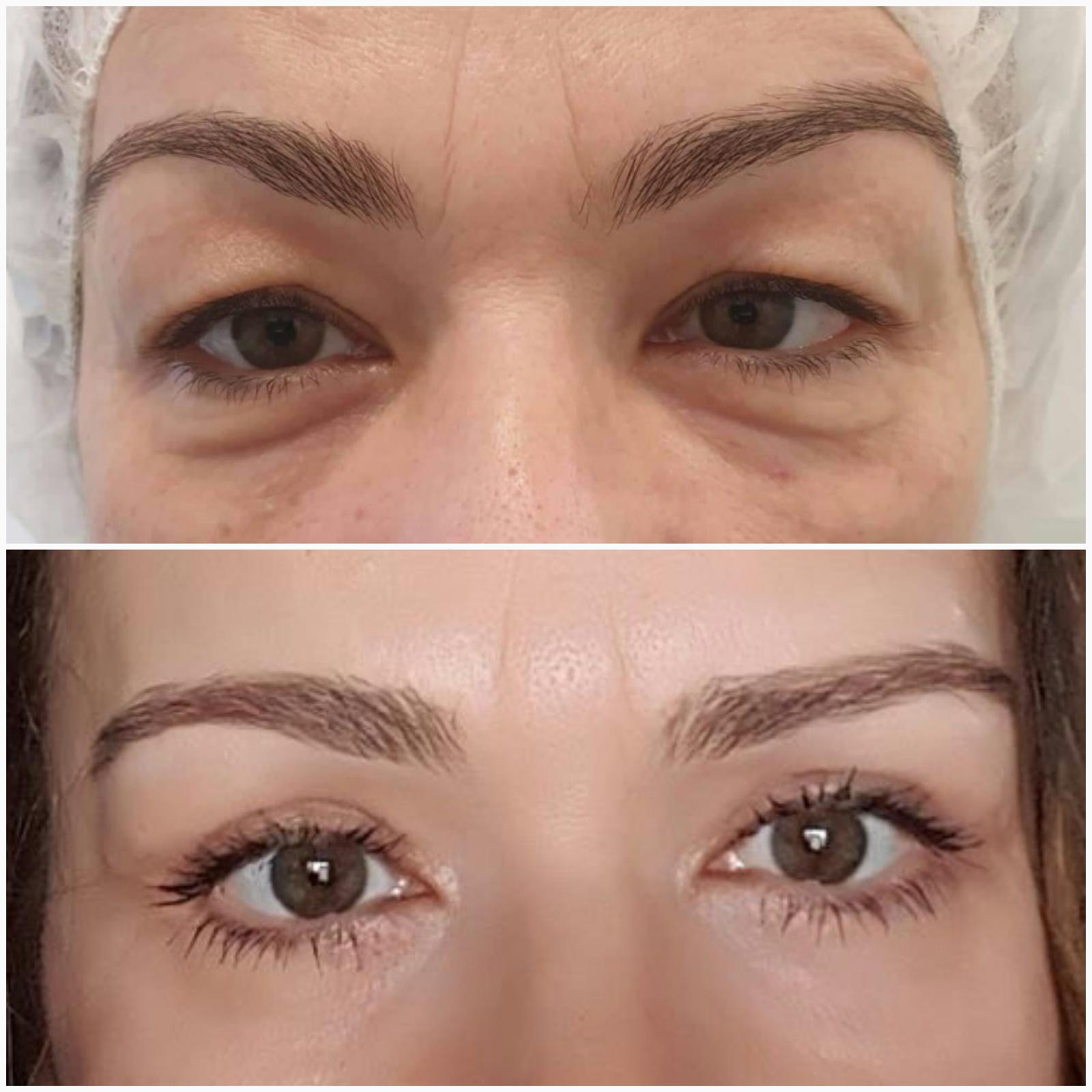 blefaroplastika24