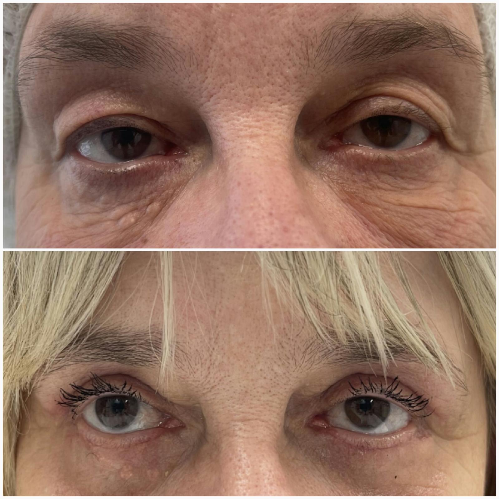 blefaroplastika25