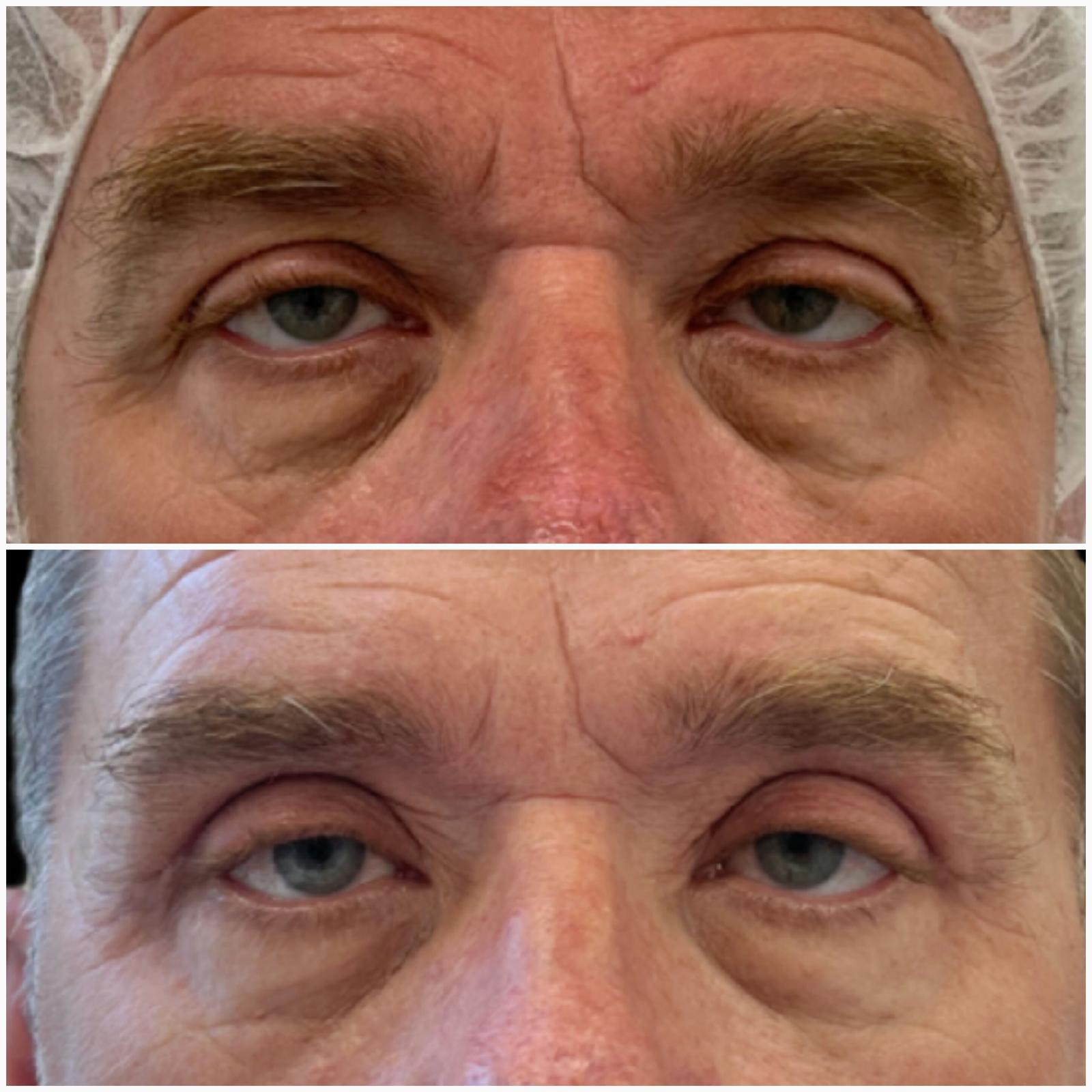 blefaroplastika3