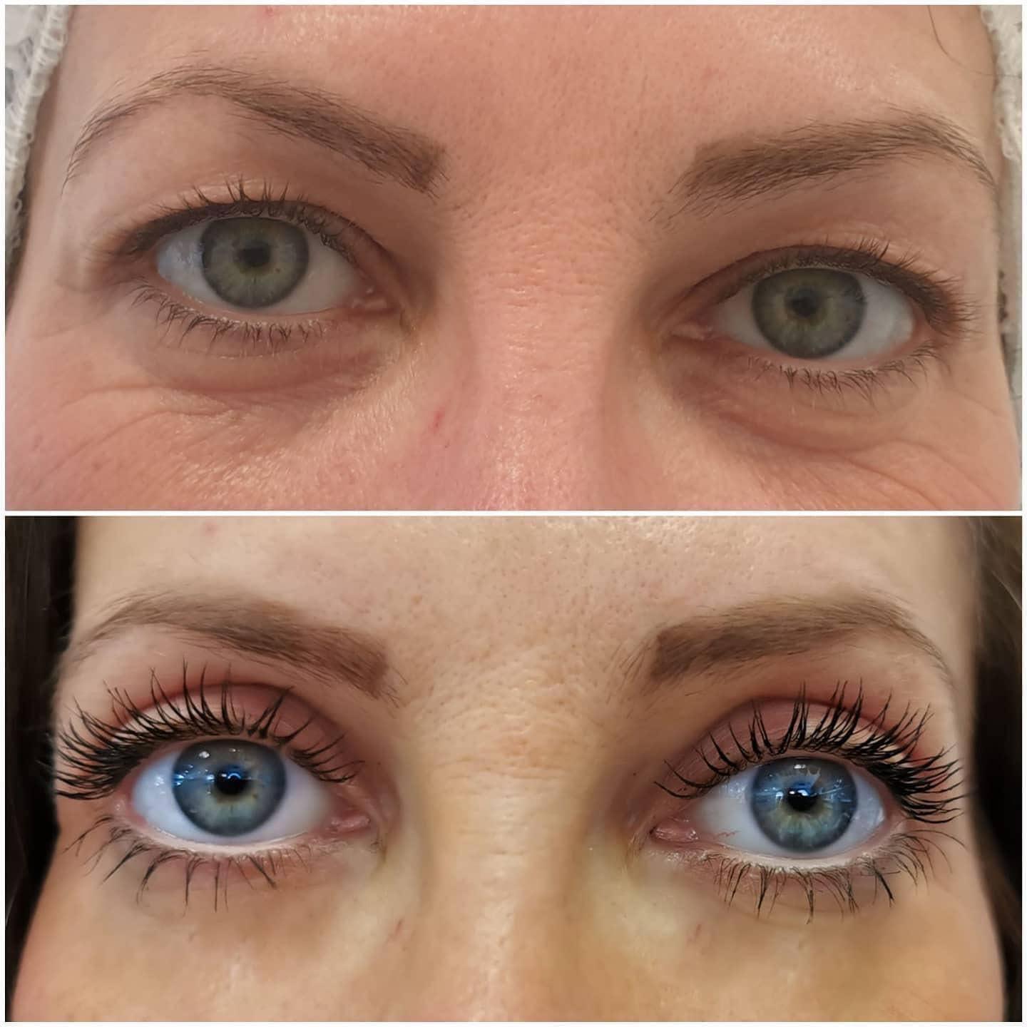 blefaroplastika30