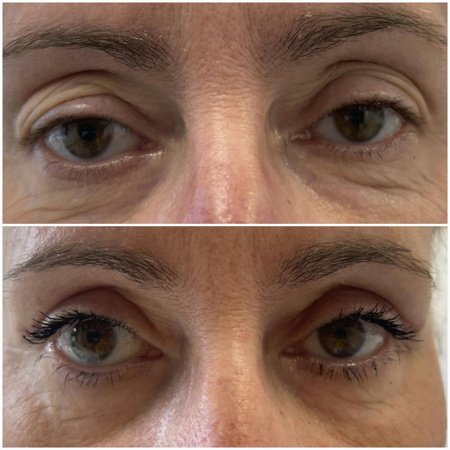 blefaroplastika31