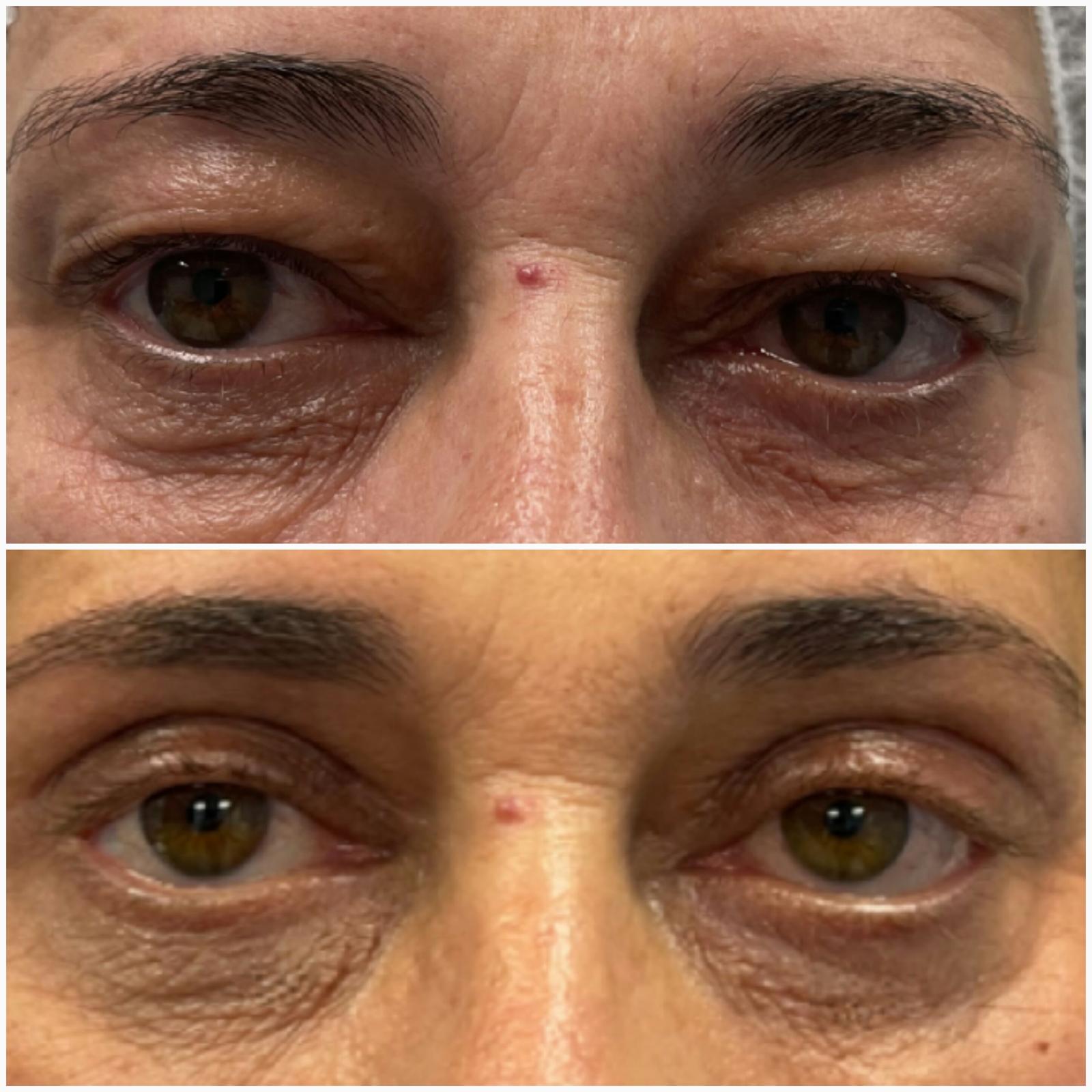 blefaroplastika33