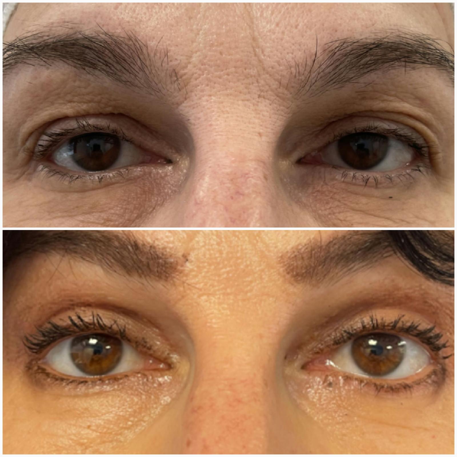 blefaroplastika34