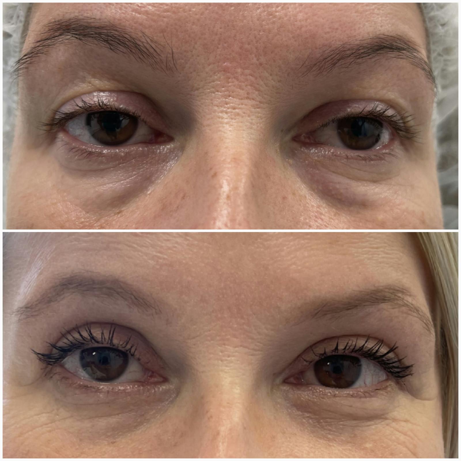 blefaroplastika36