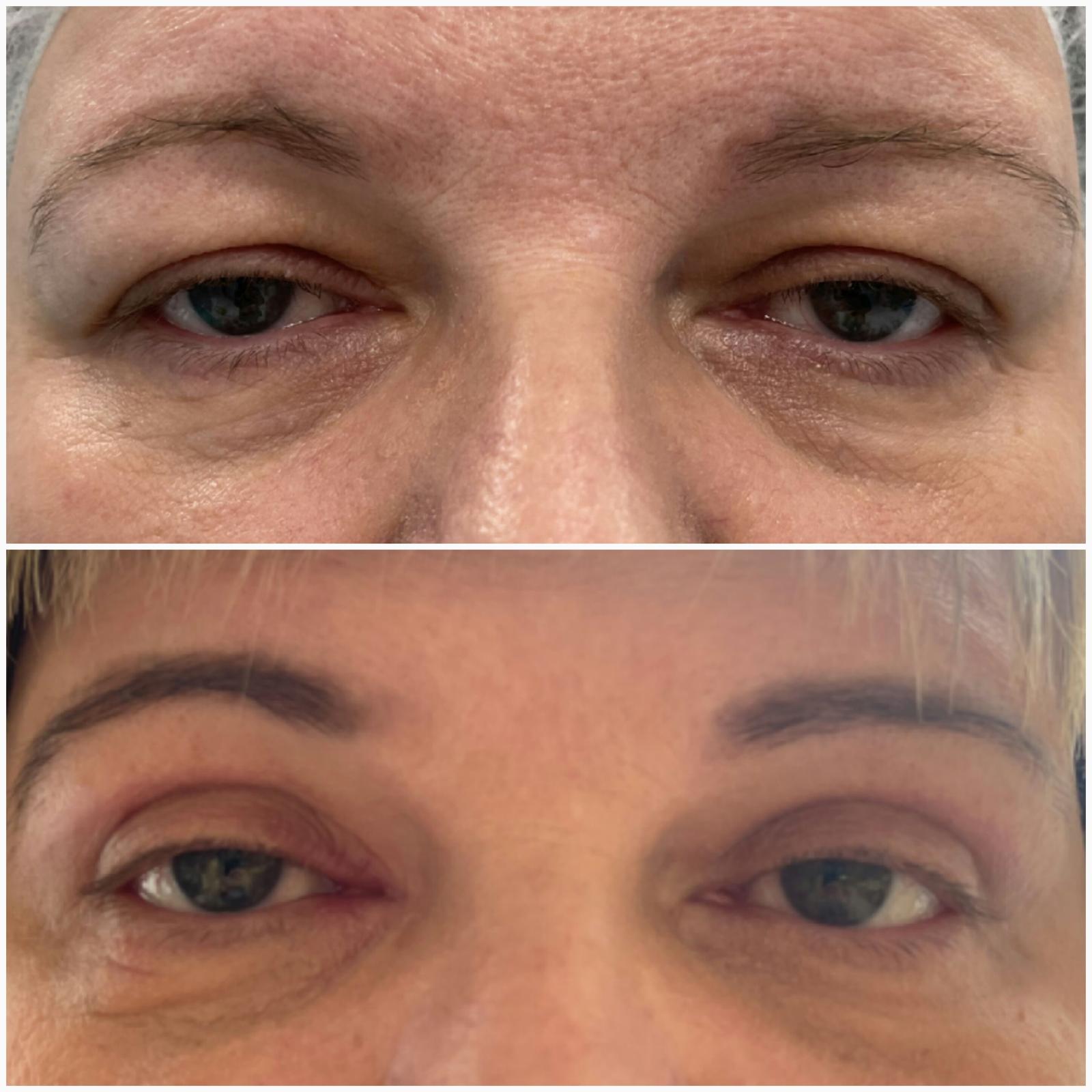 blefaroplastika38