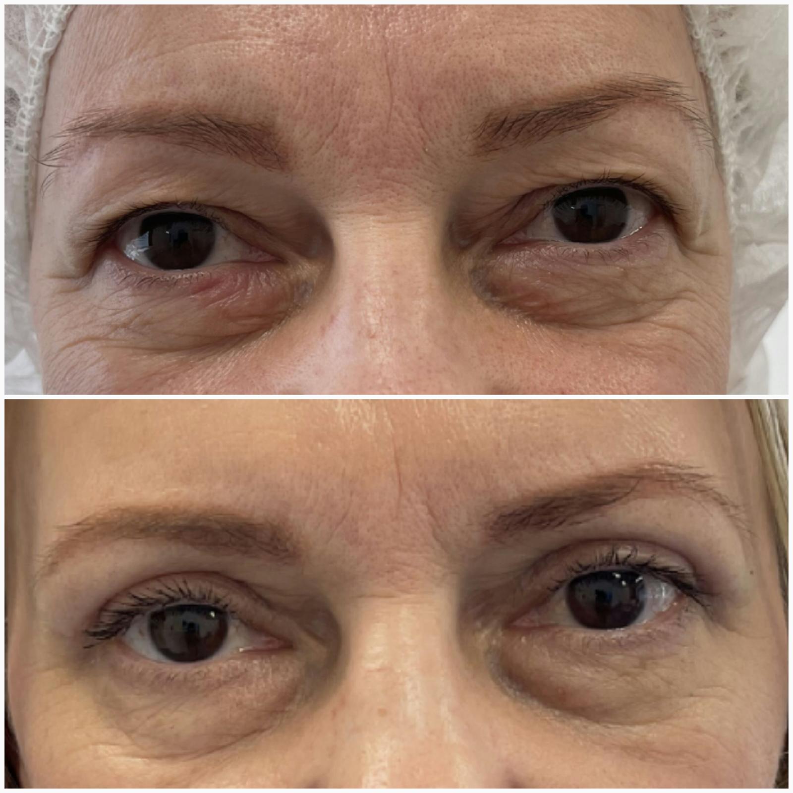 blefaroplastika40