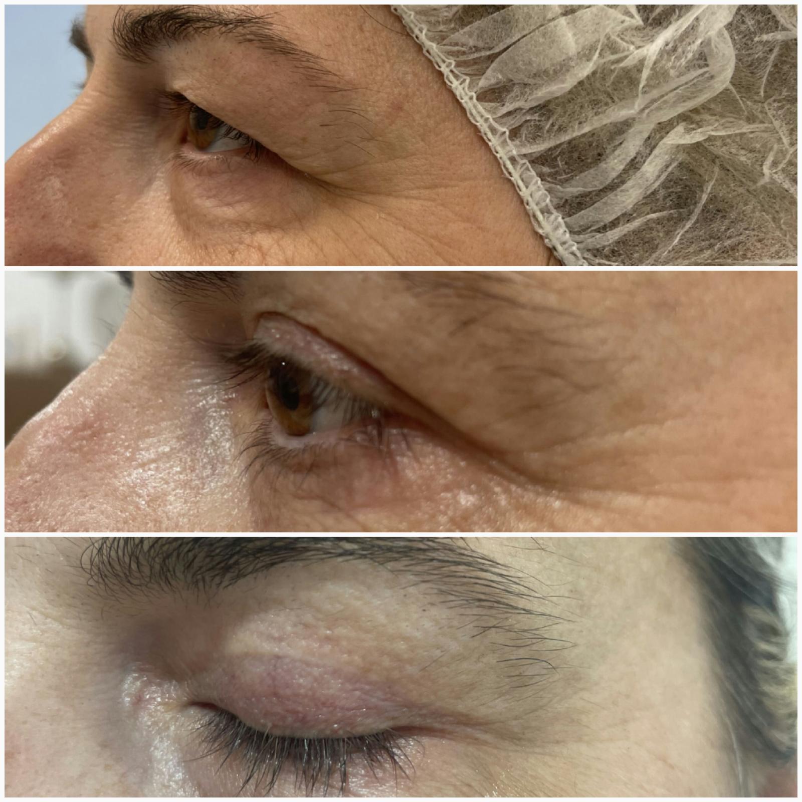 blefaroplastika41