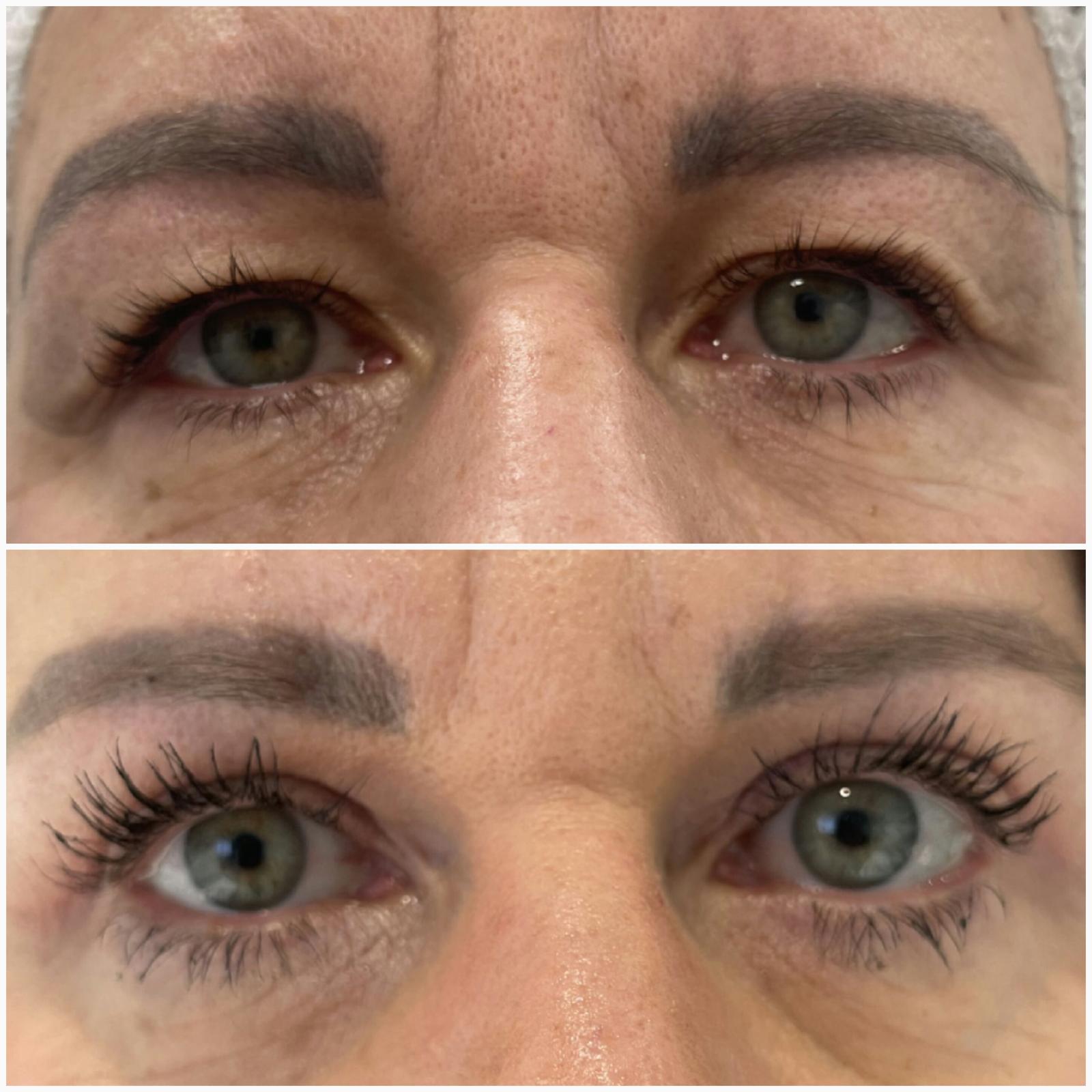 blefaroplastika42