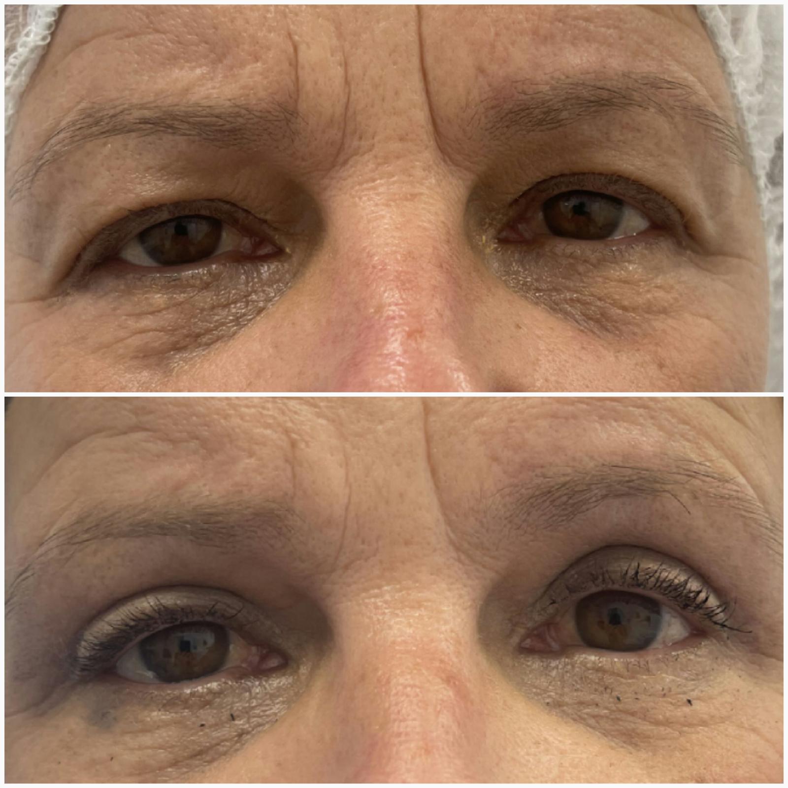 blefaroplastika43