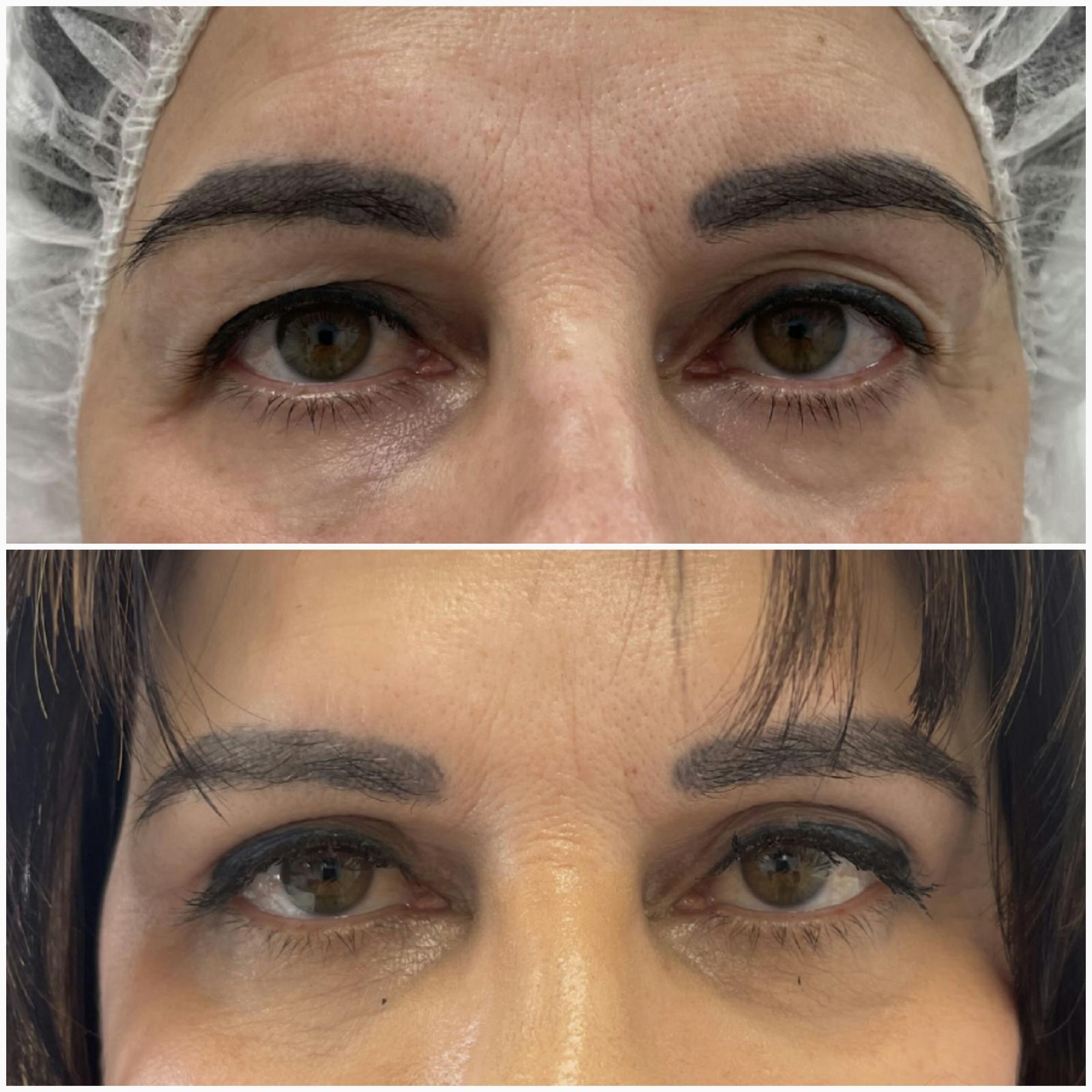 blefaroplastika44