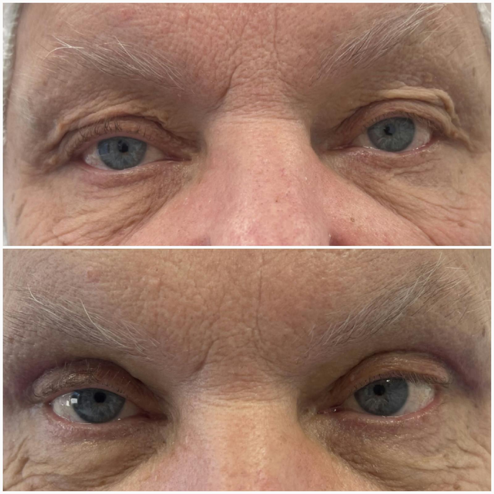 blefaroplastika45