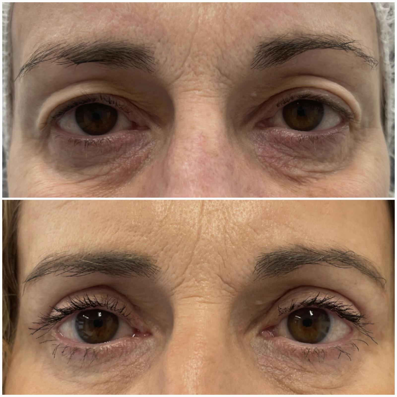 blefaroplastika46