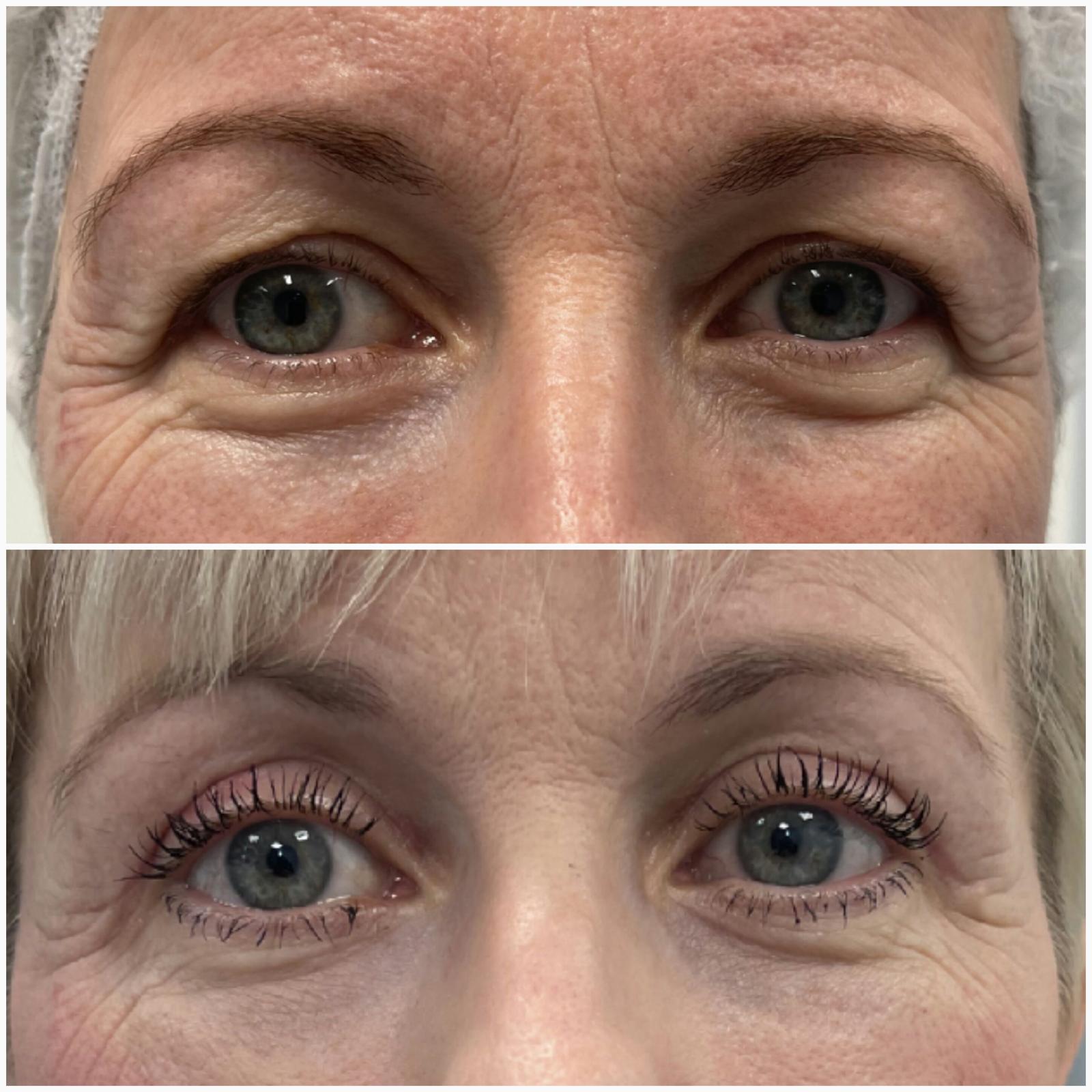 blefaroplastika47