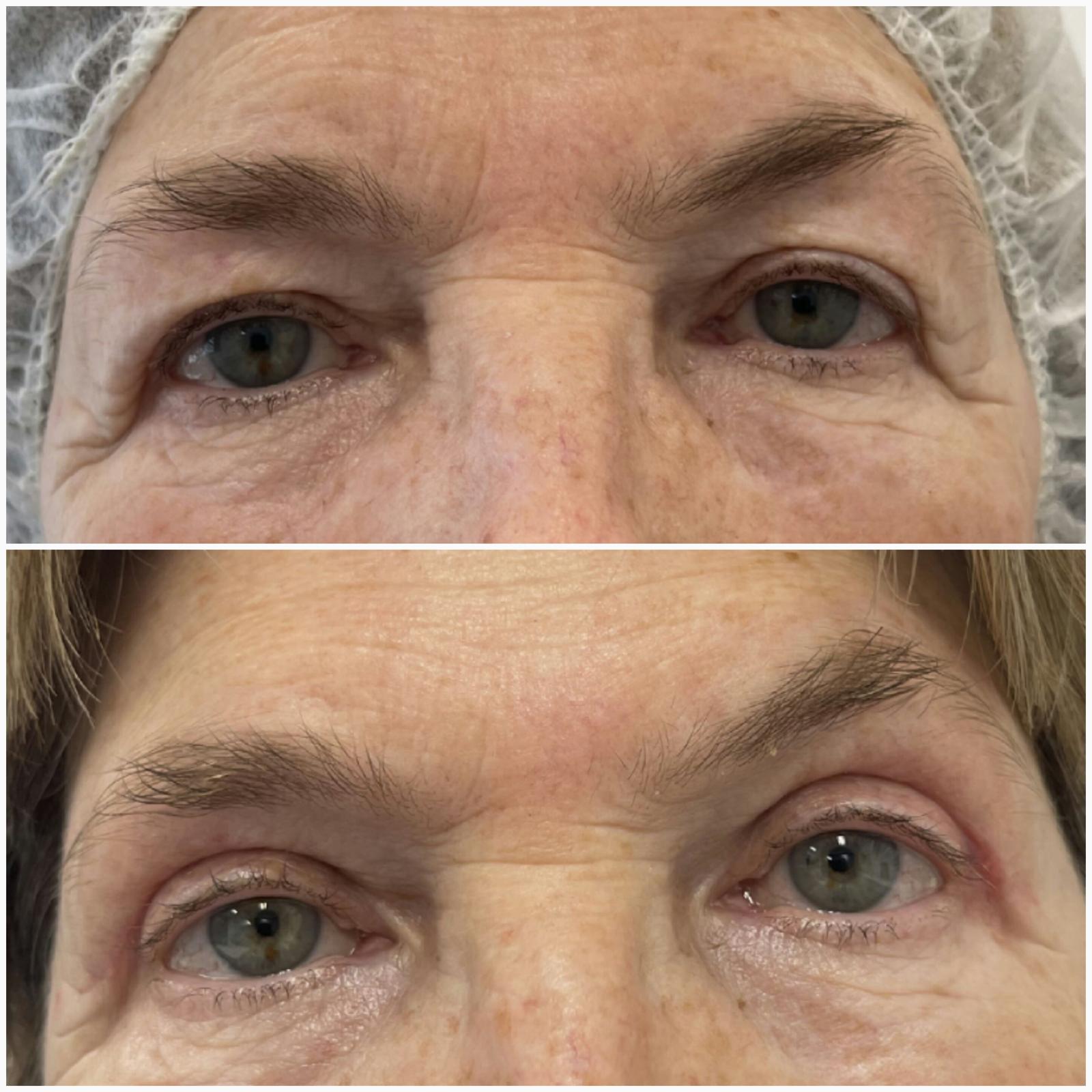 blefaroplastika48