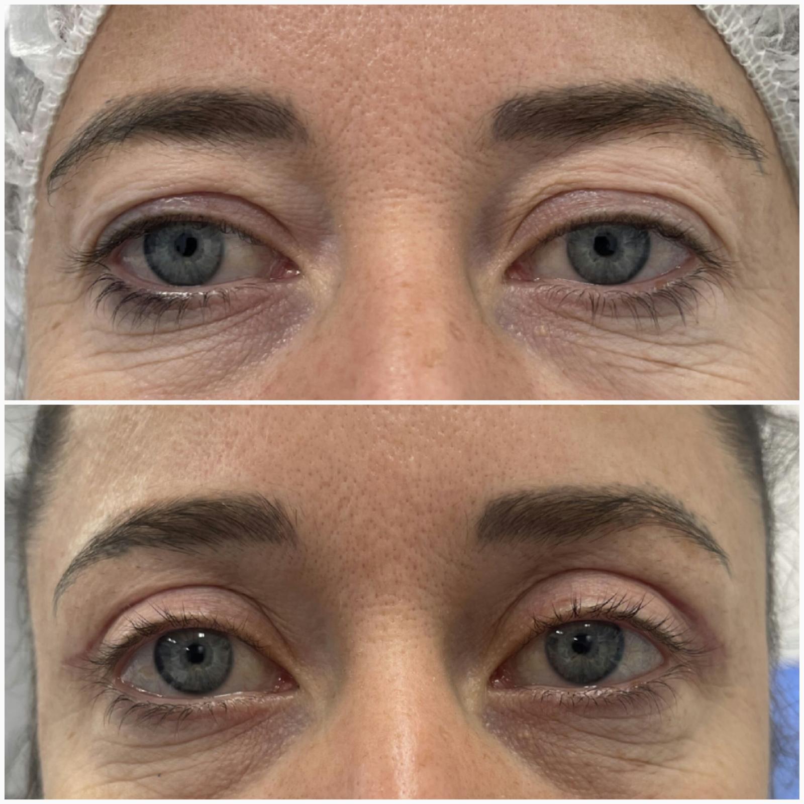 blefaroplastika49