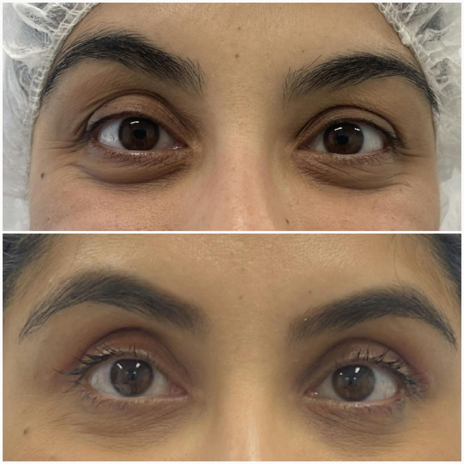 blefaroplastika50