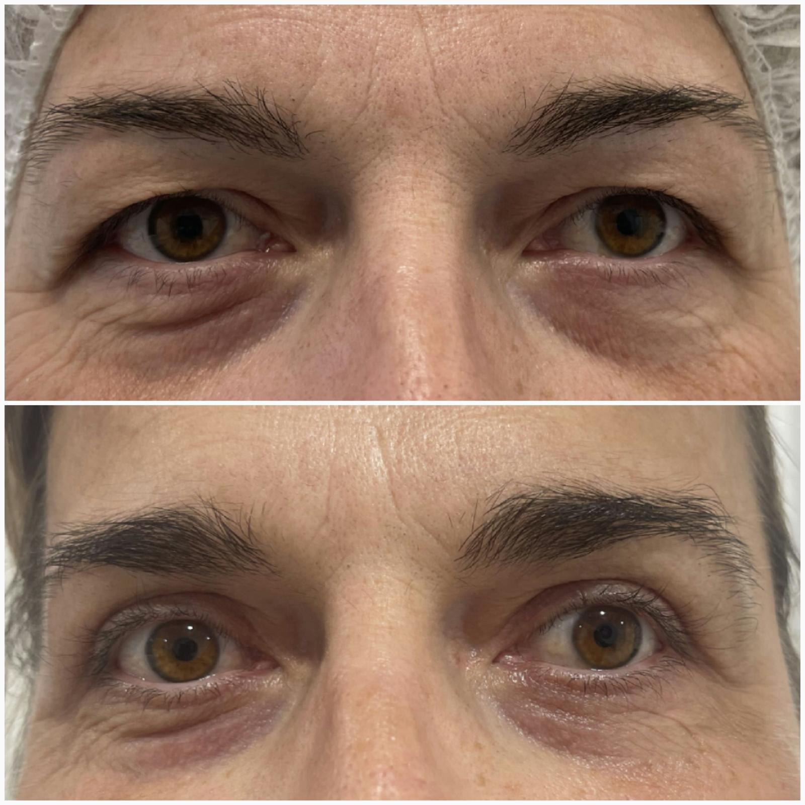 blefaroplastika51