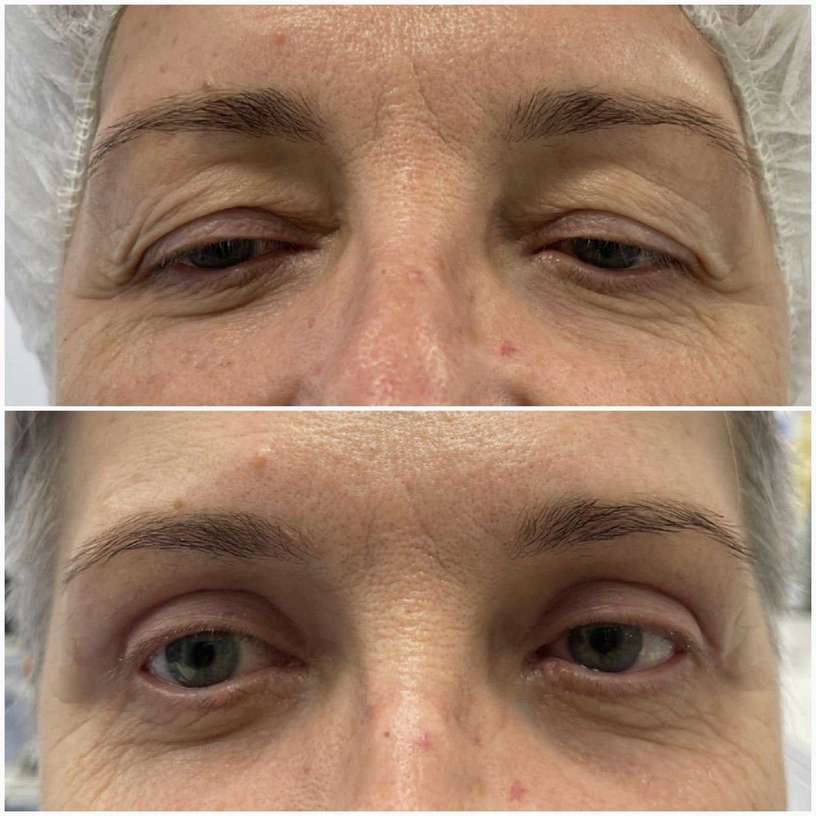 blefaroplastika52