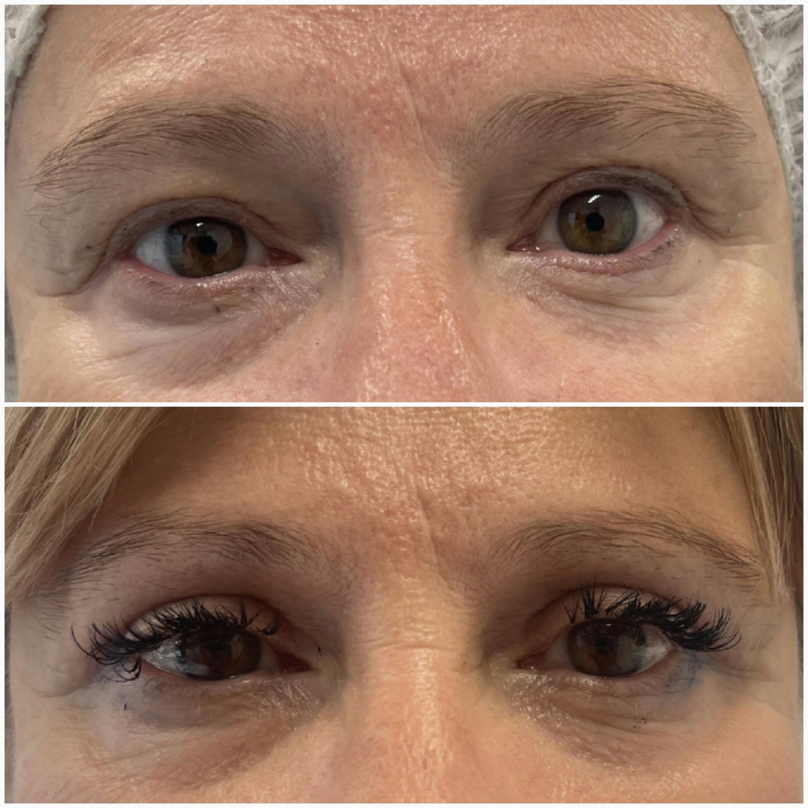 blefaroplastika53