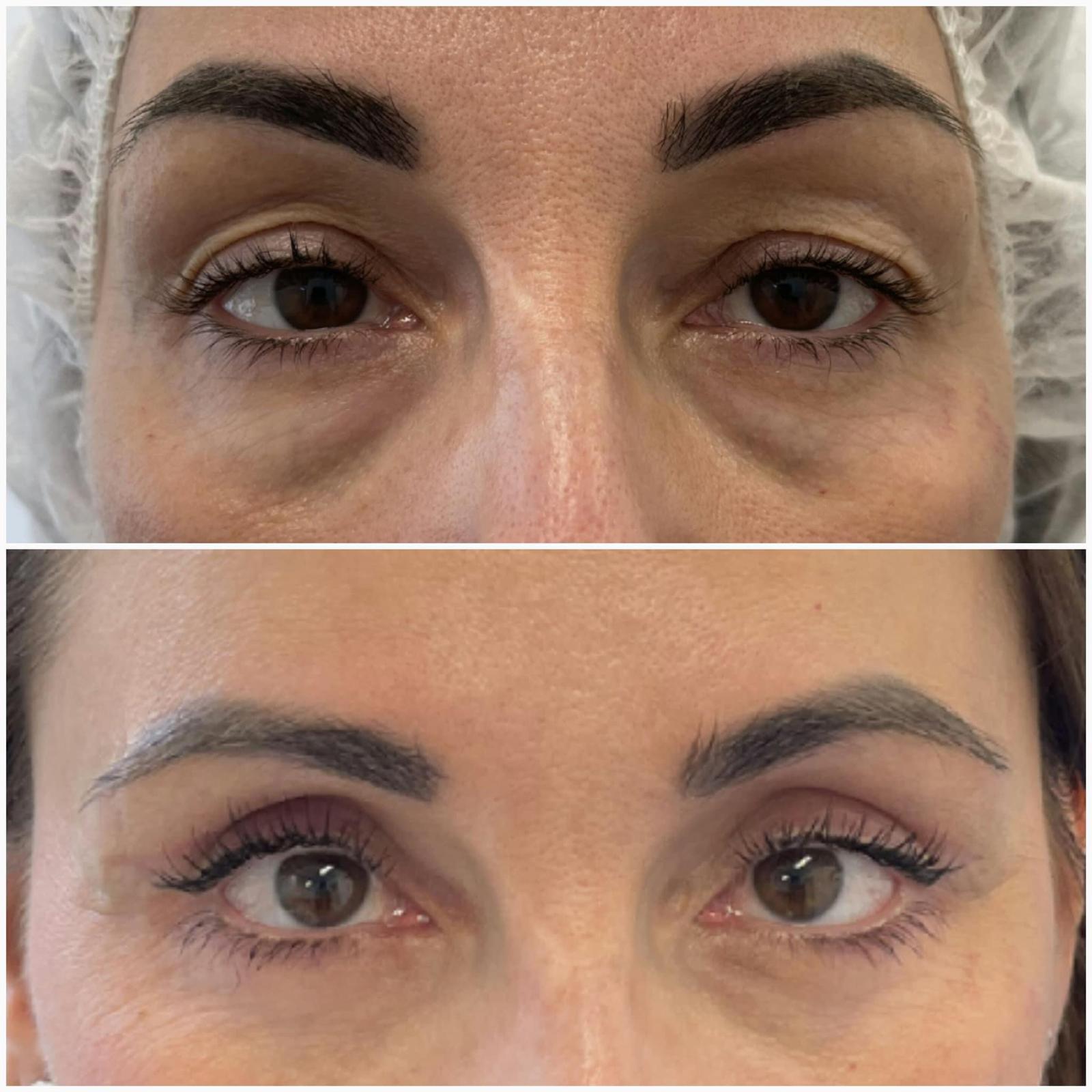 blefaroplastika6