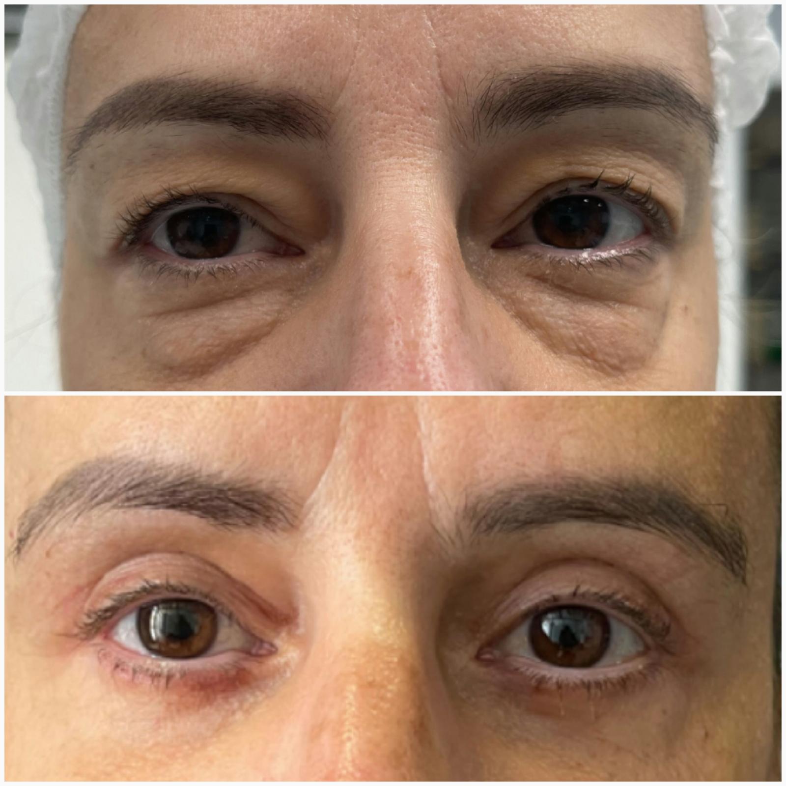 blefaroplastika7