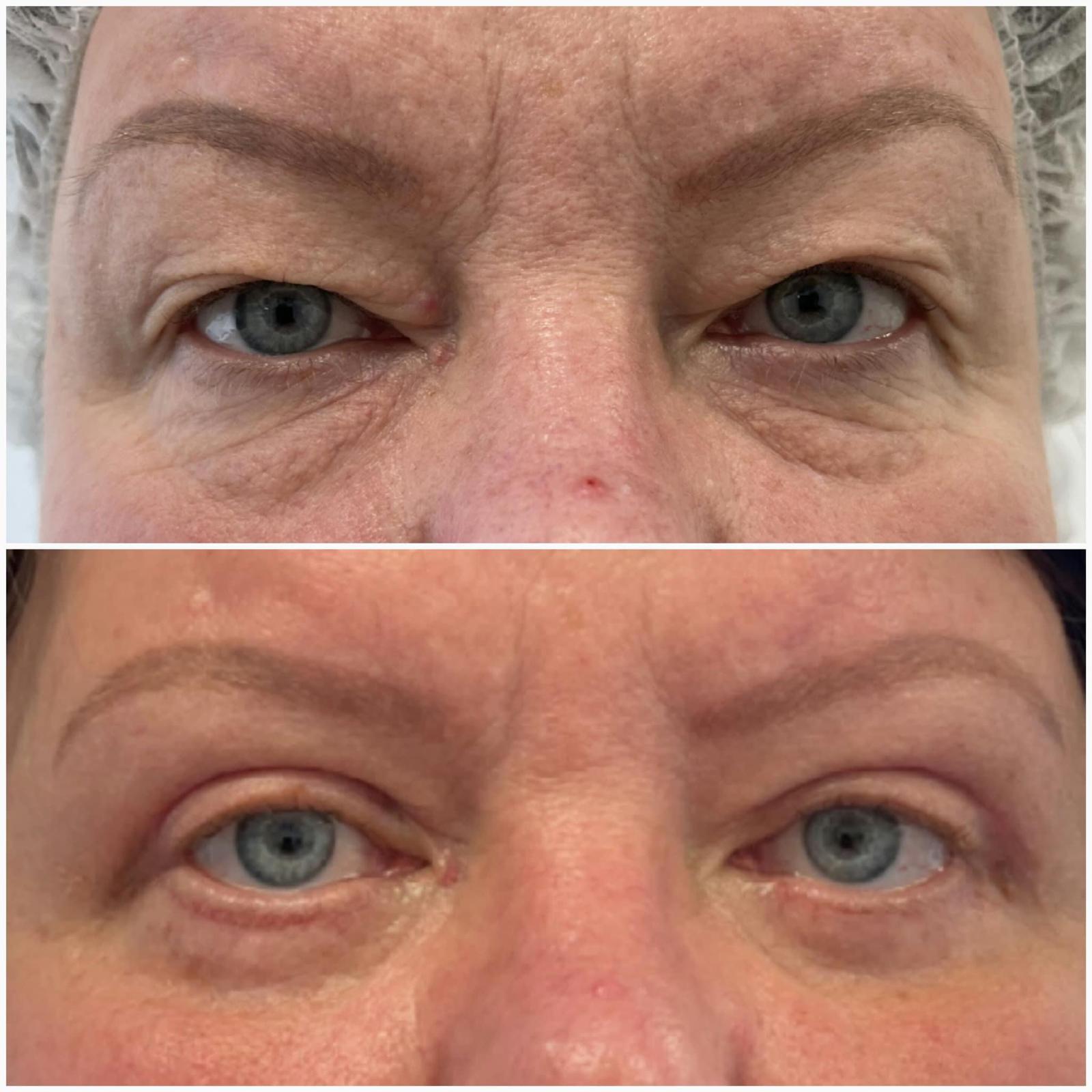 blefaroplastika8