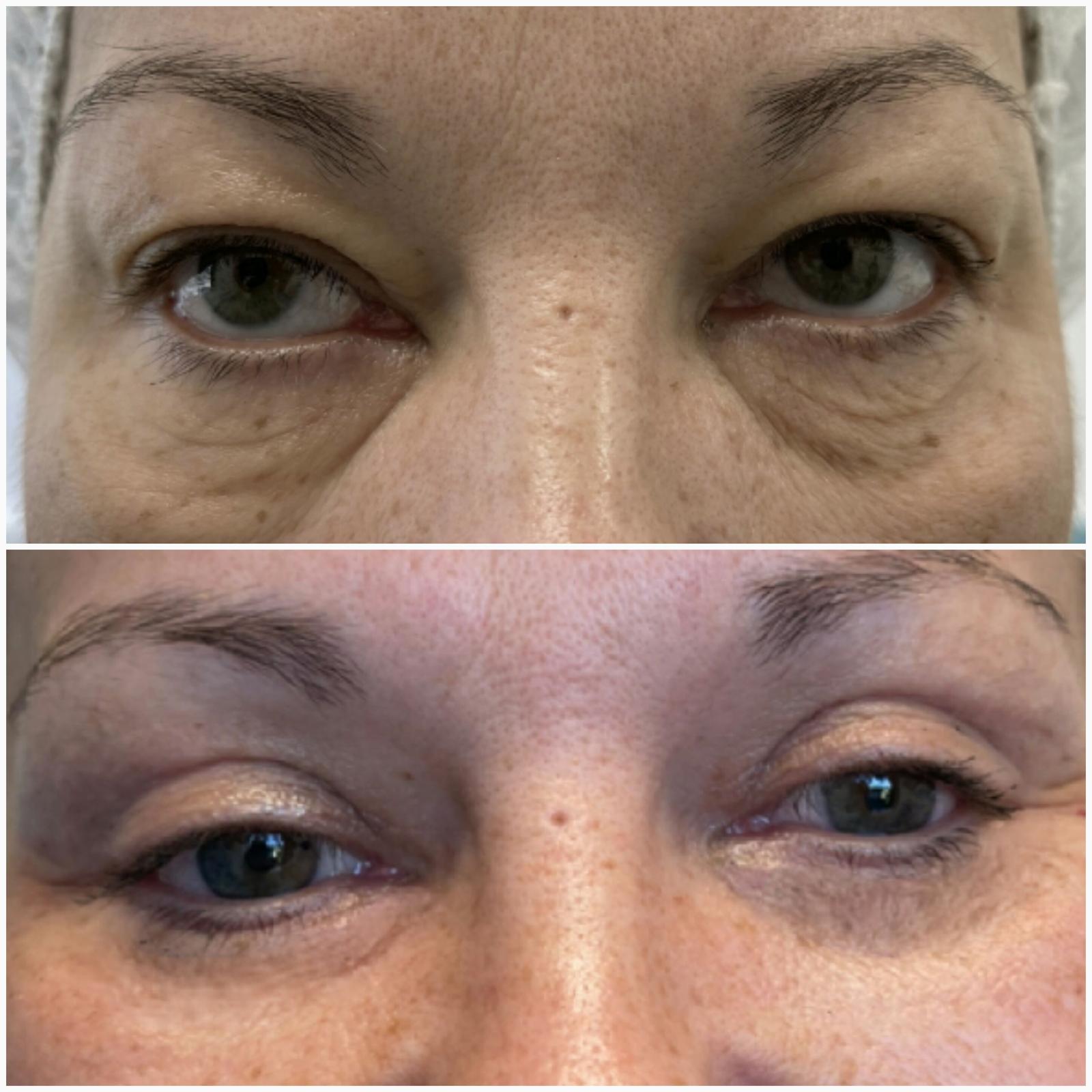 blefaroplastika9